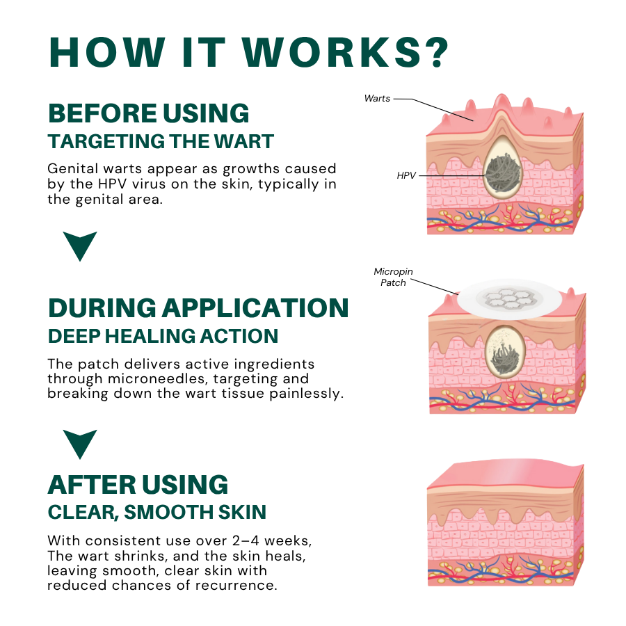 Alisanda™ Magnesium MicroPin HPV Genital Wart Removal Patch