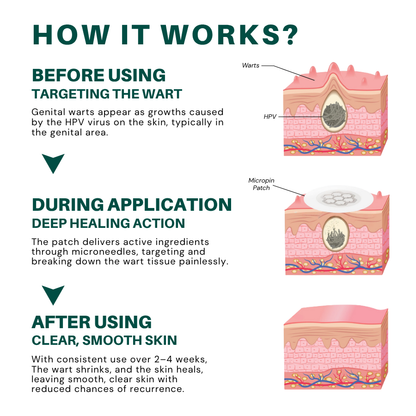 Alisanda™ Magnesium MicroPin HPV Genital Wart Removal Patch