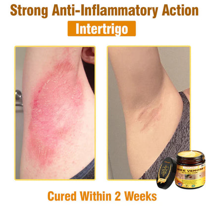 𝐋𝐎𝐕𝐈𝐋𝐃𝐒™ 𝐁𝐞𝐞 𝐕𝐞𝐧𝐨𝐦 𝐀𝐥𝐥-𝐢𝐧-𝐎𝐧𝐞 𝐂𝐫𝐞𝐚𝐦–🌸 Anti-aging,Hydrating, Skin Repair, Even Tone, Acne and Dark Spot Treatment, Wart and Mole Removal, Psoriasis Relief